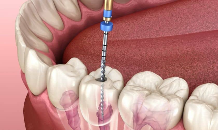 Root Canals in Gresham, OR