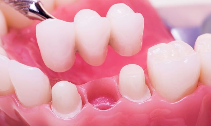 The Secrets to Prolonging the Lifespan of Your Dental Crowns through