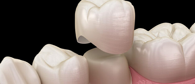 Illustration of a porcelain dental crown being placed at Gresham Advanced Dentistry in Gresham, OR