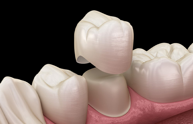 Gresham Advanced Dentistry – Dental Crown Restoration Illustration of a porcelain dental crown being placed at Gresham Advanced Dentistry in Gresham, OR