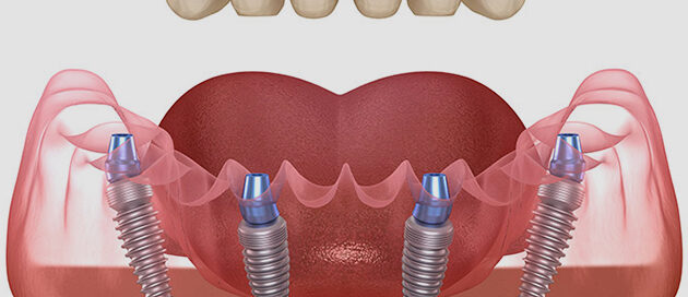 All-On-4 full-arch implant bridge illustration at Gresham Advanced Dentistry in Gresham, OR