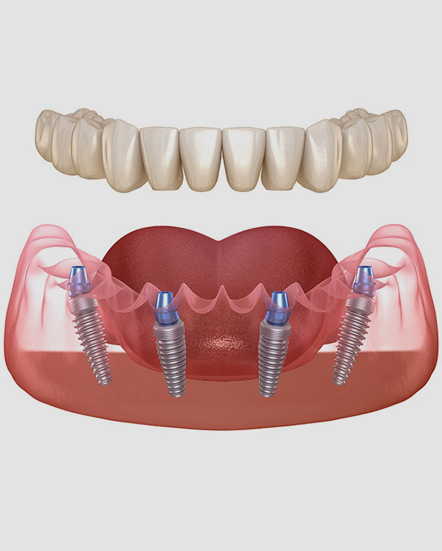 Gresham Advanced Dentistry – All-On-4 Full Arch All-On-4 full-arch implant bridge illustration at Gresham Advanced Dentistry in Gresham, OR