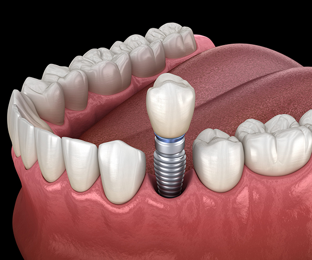 Illustration of a single dental implant among natural teeth at Gresham Advanced Dentistry in Gresham, OR