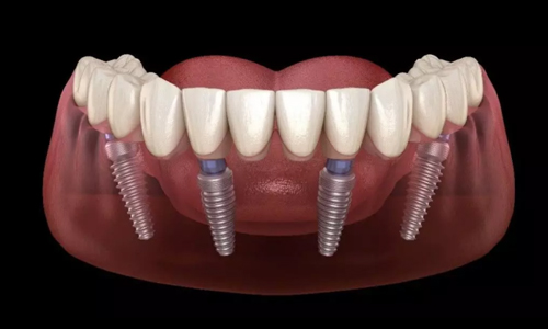 Full-mouth dental implants illustration at Gresham Advanced Dentistry in Gresham, OR