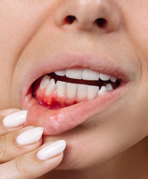 Gresham Advanced Dentistry – Gum Disease Treatment Close-up of inflamed gums showing early gum disease, treated at Gresham Advanced Dentistry in Gresham, OR