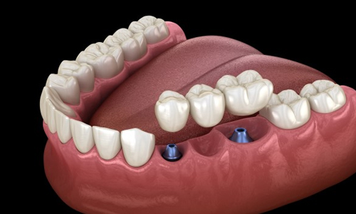 Single tooth implant and bridge illustration at Gresham Advanced Dentistry in Gresham, OR