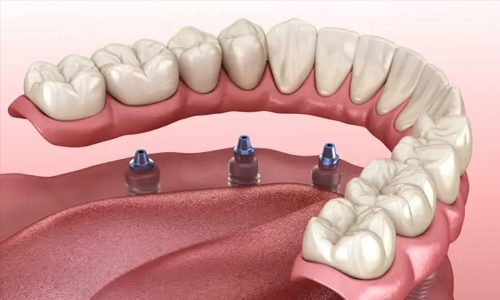 Snap-in implant denture illustration at Gresham Advanced Dentistry in Gresham, OR