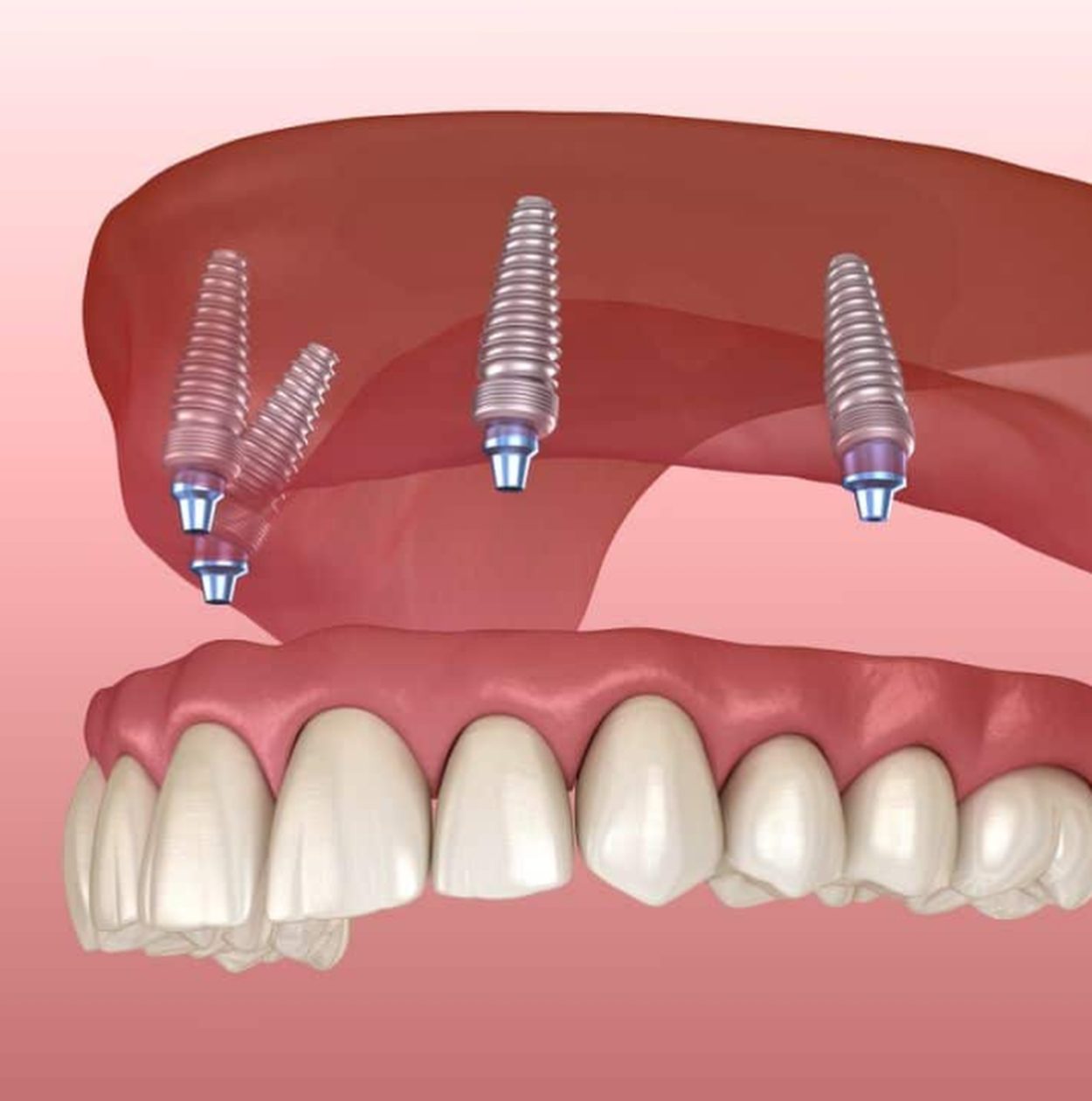 Gresham Advanced Dentistry – Snap-In Denture Diagram Diagram of snap-in implant dentures attaching to dental implants at Gresham Advanced Dentistry in Gresham, OR