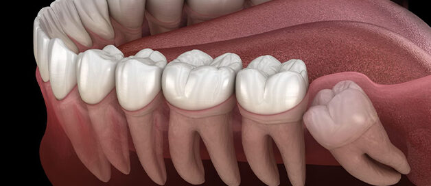Illustration of an impacted wisdom tooth pressing against neighboring molars, treated at Gresham Advanced Dentistry in Gresham, OR
