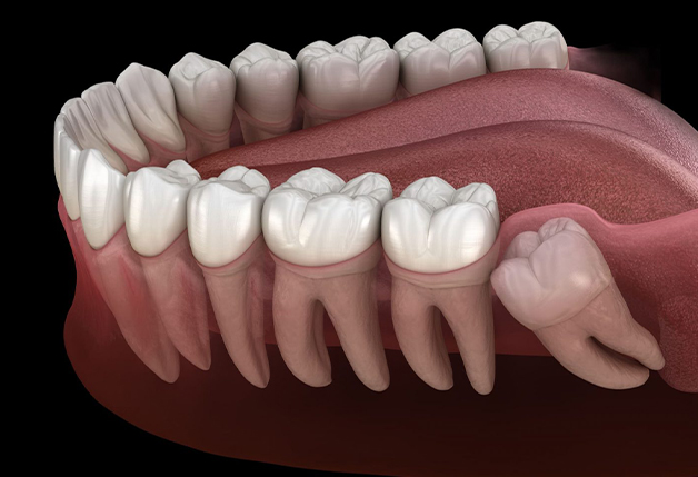 Illustration of an impacted wisdom tooth pressing against neighboring molars, treated at Gresham Advanced Dentistry in Gresham, OR
