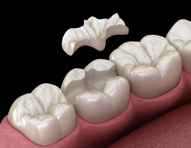 Gresham Advanced Dentistry – Dental Inlays and Onlays Illustration of a dental inlay restoration at Gresham Advanced Dentistry in Gresham, OR