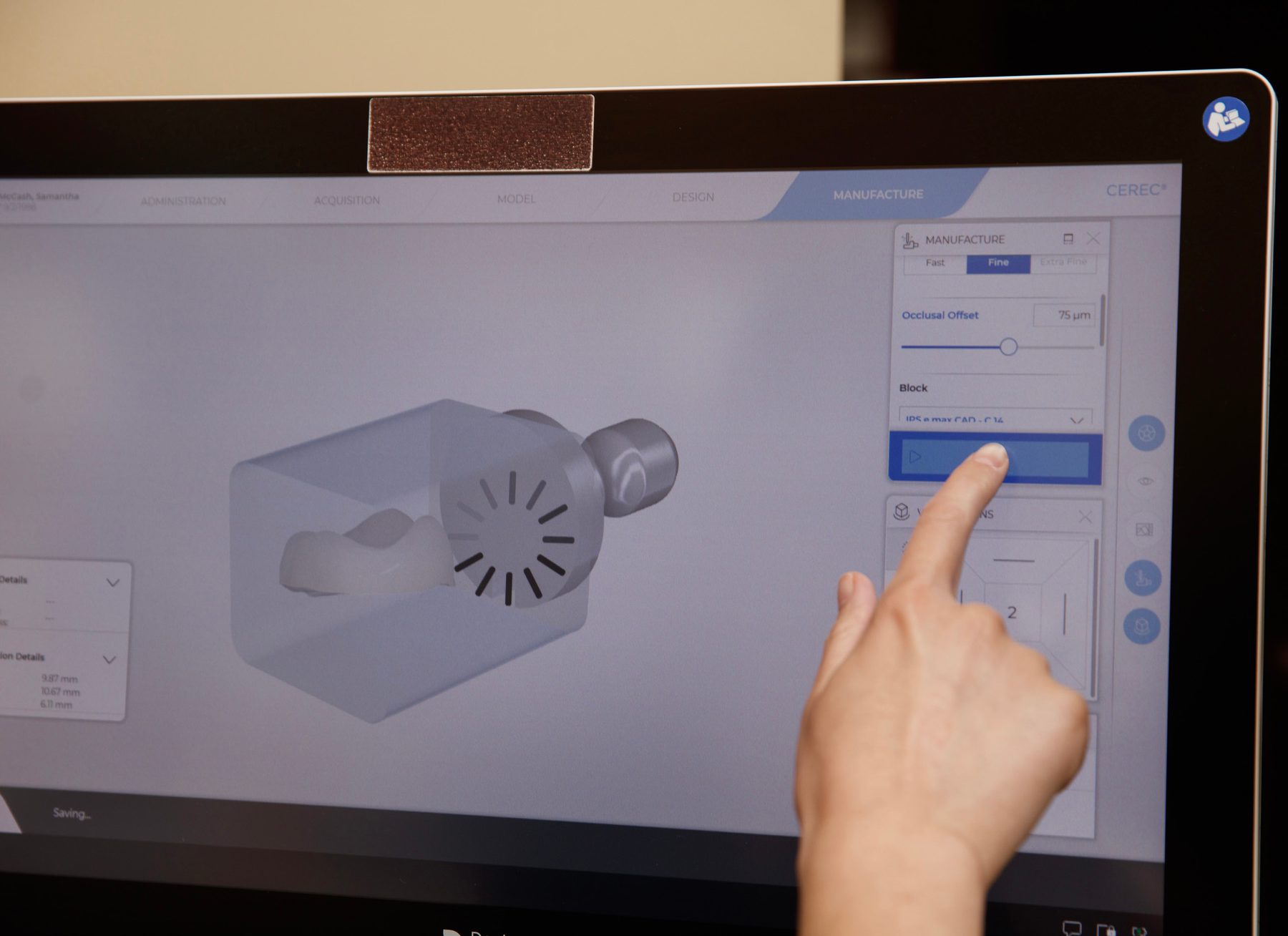 gad-awb-cerec-crown-design Crown being designed in CEREC software on a chairside touchscreen